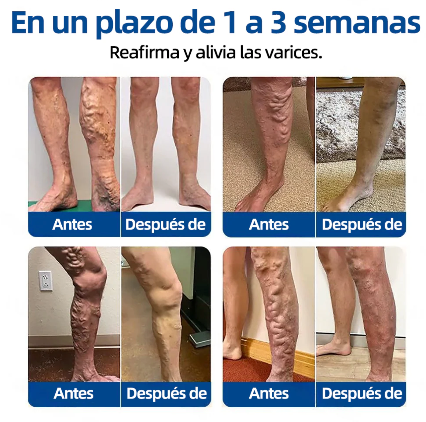 Tienda Oficial | 𝐻𝑒𝑎𝑙𝑟𝑖𝑧𝑒® Piernas Ligeras 12-en-1 🩹 Advanced Nano Microneedle Patch 🇲🇽 (Una vez al día · resultados en 7 días) 👨‍⚕️ Para várices, Reduce arañitas, mejora circulación, alivia piernas cansadas  y esa pesadez que no te deja estar cómoda 💝