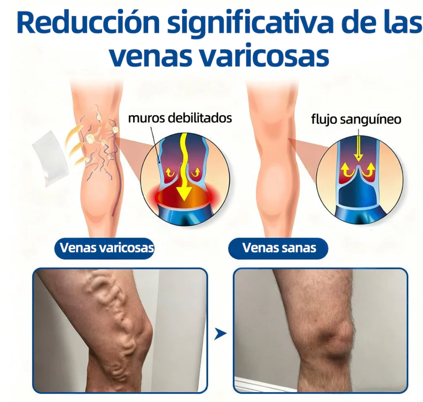 Tienda Oficial | 𝐻𝑒𝑎𝑙𝑟𝑖𝑧𝑒® Piernas Ligeras 12-en-1 🩹 Advanced Nano Microneedle Patch 🇲🇽 (Una vez al día · resultados en 7 días) 👨‍⚕️ Para várices, Reduce arañitas, mejora circulación, alivia piernas cansadas  y esa pesadez que no te deja estar cómoda 💝